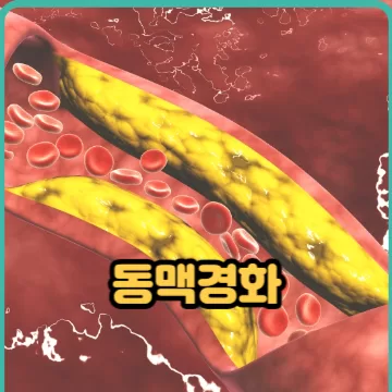 동맥경화 증상 그리고 원인